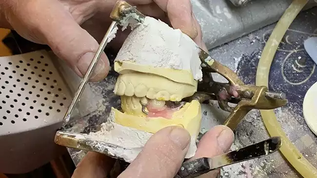 Placing Teeth For Cast Partial Denture Center Missoula Mt